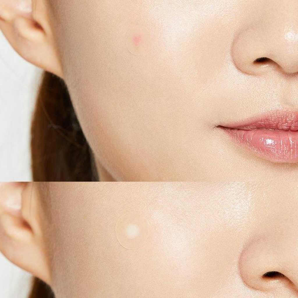 COSRX Acne Pimple Master Patch Pack - 96 patches